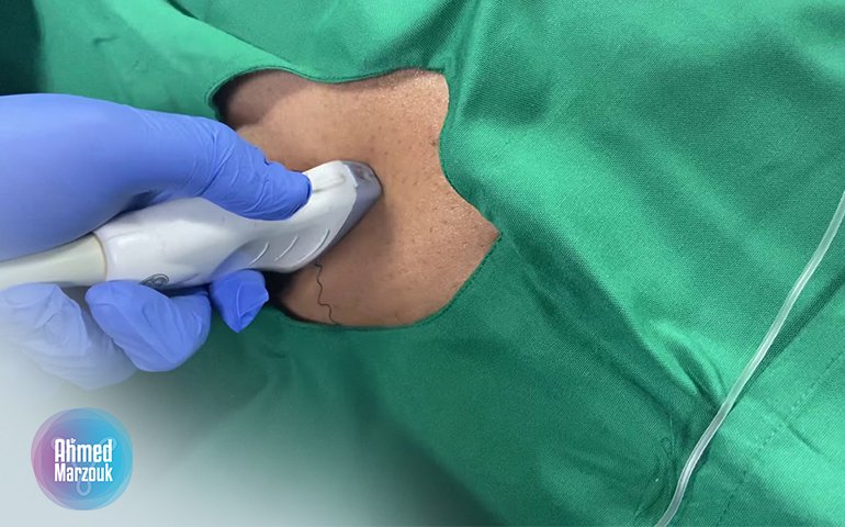 الولادة بدون ألم تاب بلوك